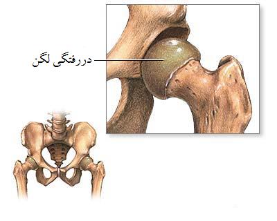 علل دررفتگی مفصل لگن